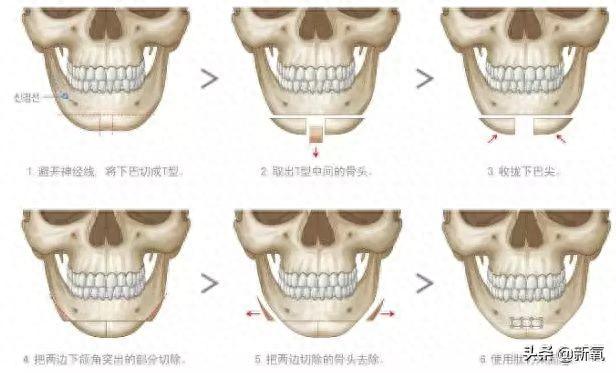 美嘉、小姨妈修复回颜值巅峰，娄艺潇却顶着比鸡蛋还圆乎的苹果肌