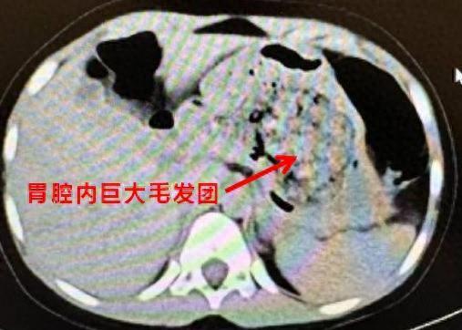 发现1例，5岁女孩确诊！多地已有病例，医生：警惕这些异常→