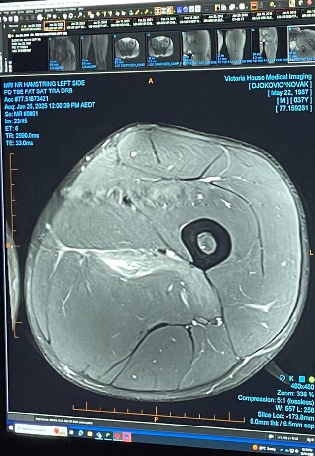 意大利网协主席狂奶辛纳讥讽德约，德约晒核磁检查图片回应质疑