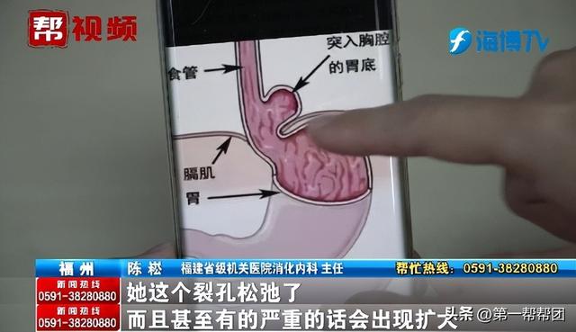 女子长期恶心、反酸，竟因胃跑入胸腔？医生：这个作息习惯很不好