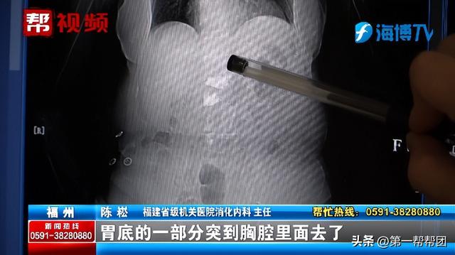 女子长期恶心、反酸，竟因胃跑入胸腔？医生：这个作息习惯很不好